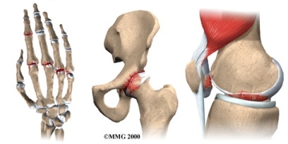 artrite articolare osteopatia