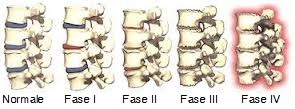 osteopatia-e-degenerazione-discale