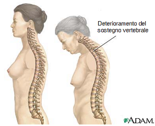 osteopatia-e-spondilosi-postura